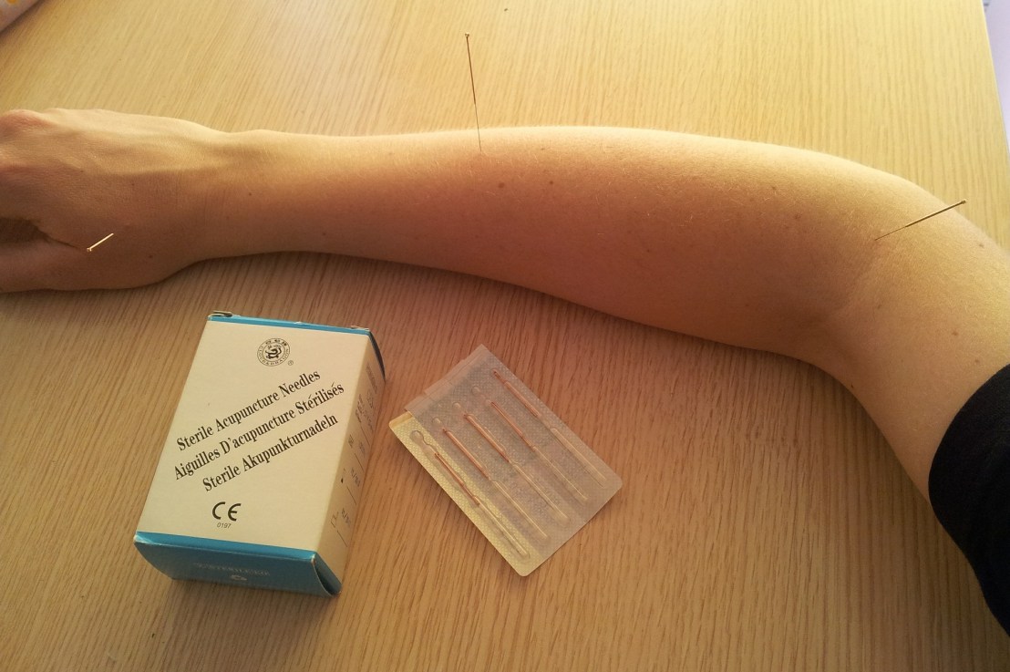 Acupuncture/Acupressure